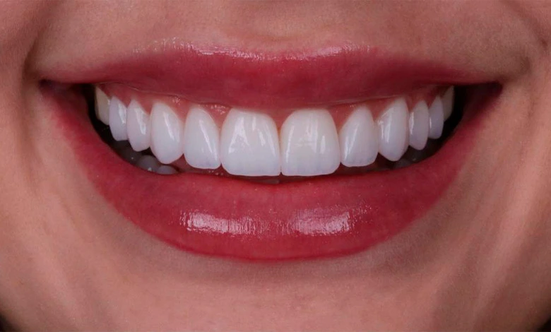 Lente de Contato em Resina - Dente Sim